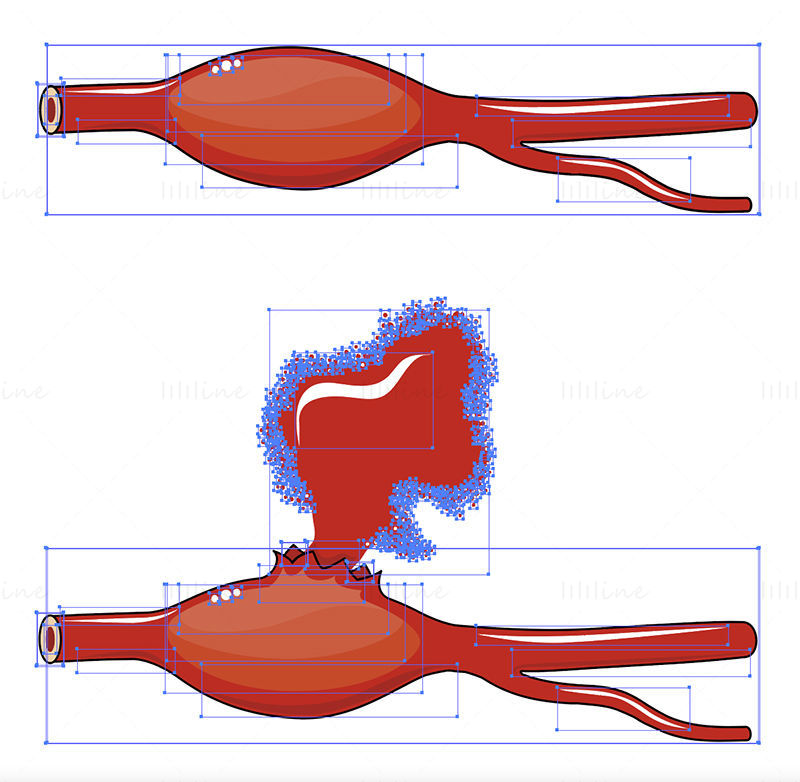 紡錘状動脈瘤のベクトル図