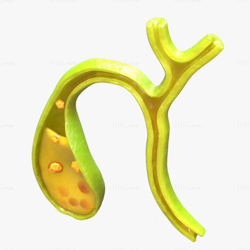 Gallenblase mit Gallensteinen 3D-Modell