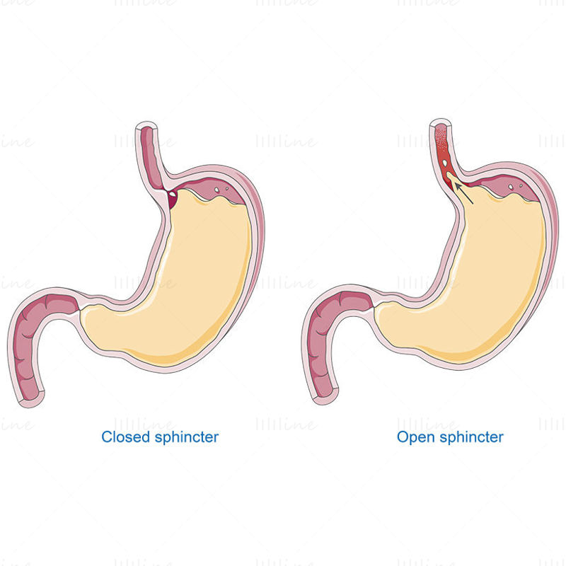 胃食管反流病 (GERD) 矢量科研绘图