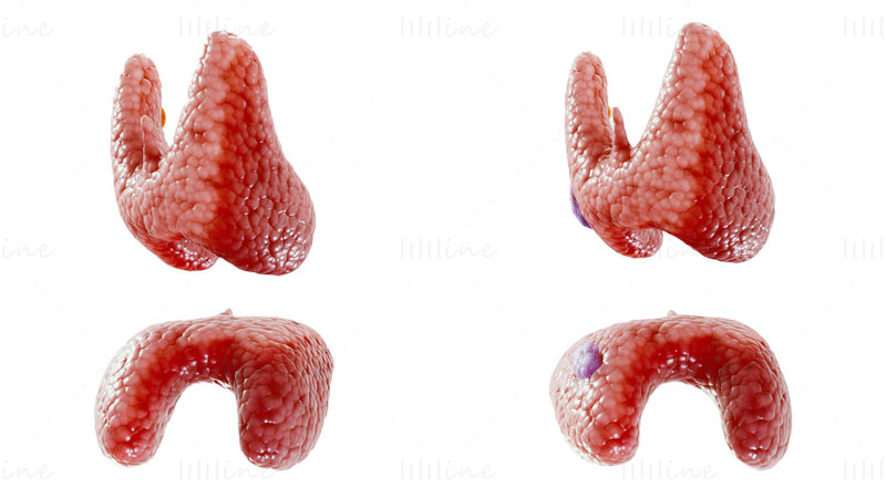 3D-Modell für gesunde Schilddrüse und Schilddrüsenkrebs