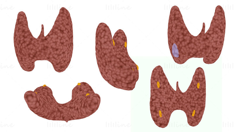 Thyroïde saine et cancer de la thyroïde modèle 3D