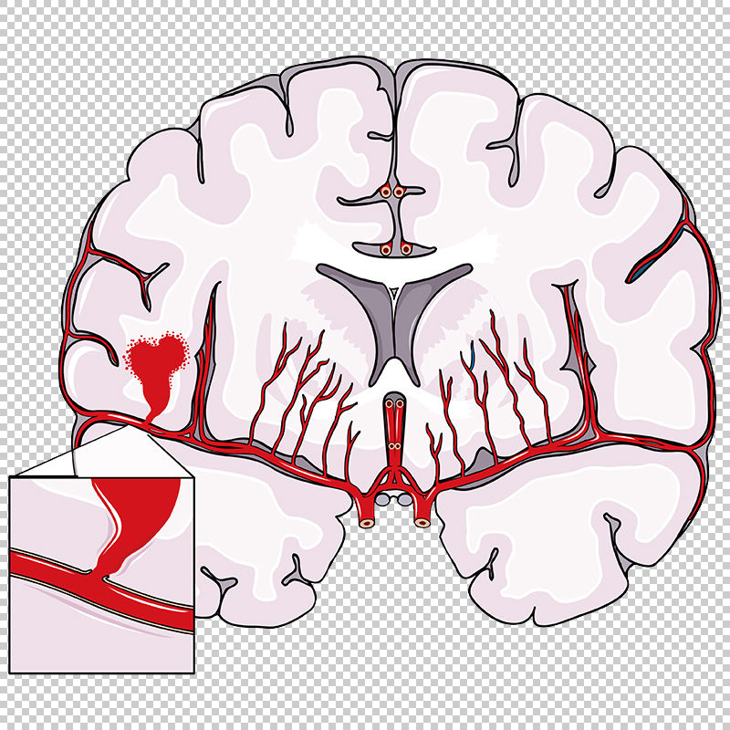 Hemorrhagic Stroke Vector Scientific Illustration