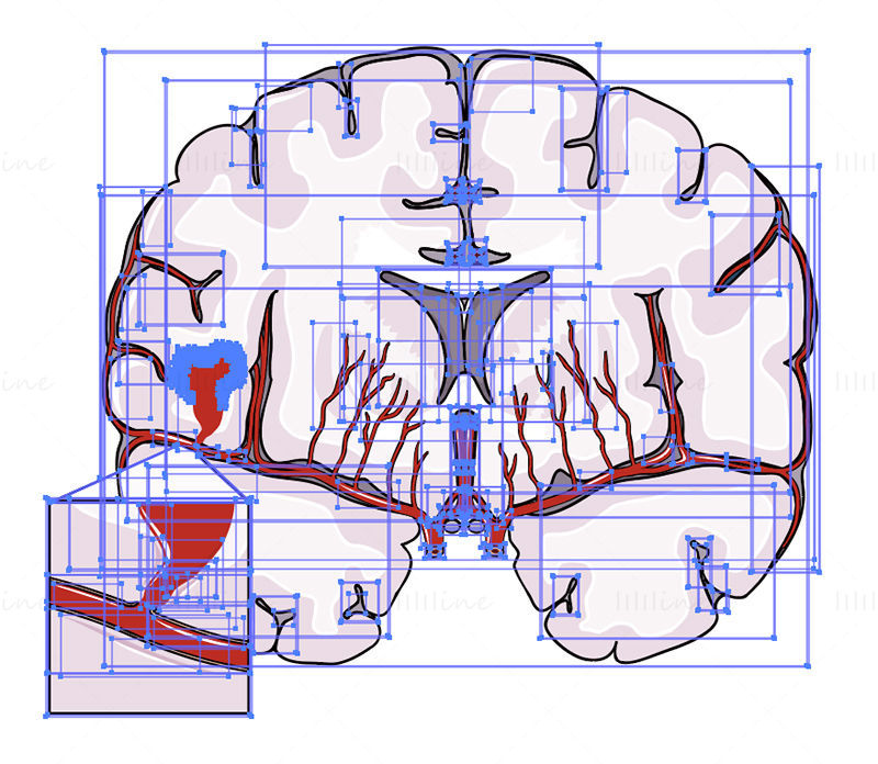 Hemorrhagic stroke vector scientific illustration