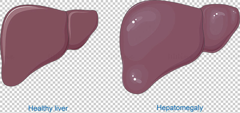 Vektor hepatomegalie