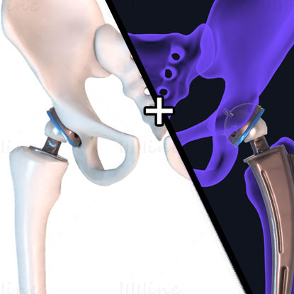 Heupvervangend implantaat geïnstalleerd in het 3D-model van het bekkenbot