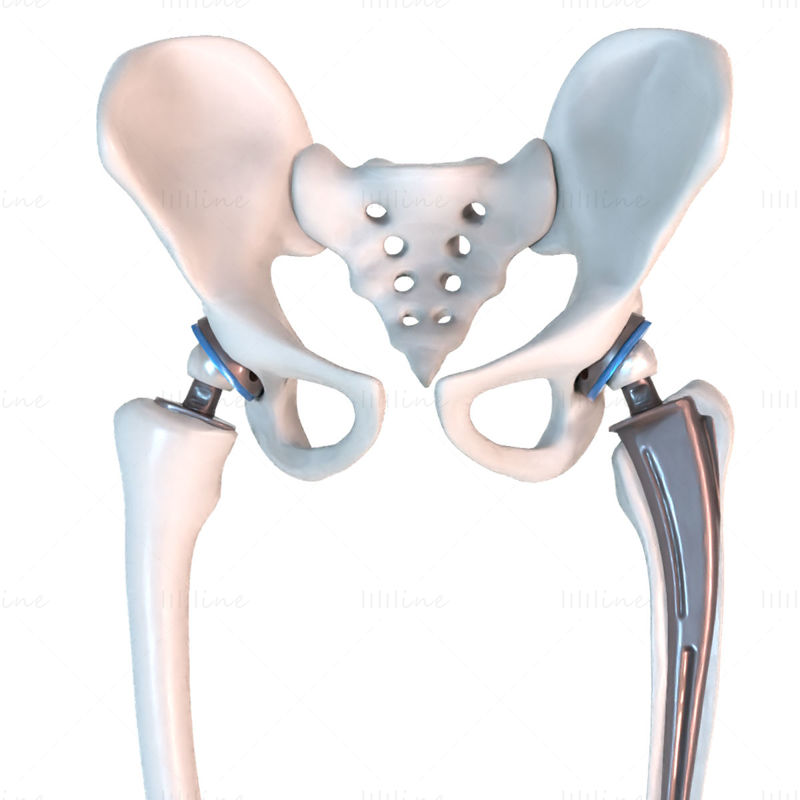 Hofteproteseimplantat installert i bekkenbenets 3D-modell