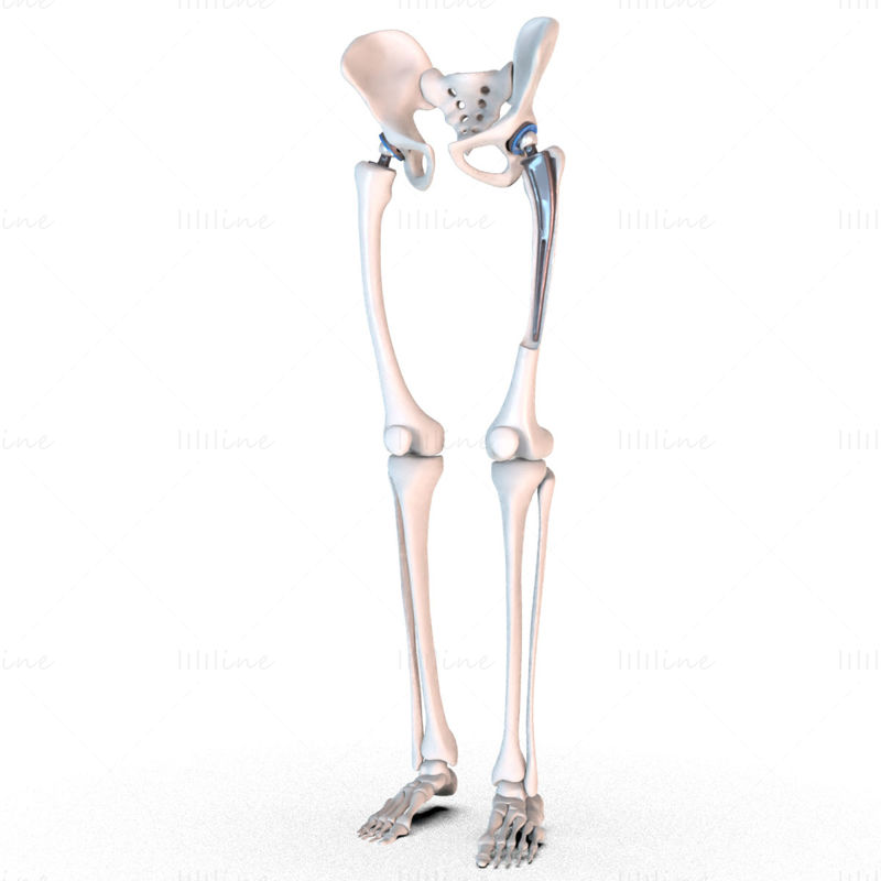 Имплантат для замены тазобедренного сустава, установленный в 3D-модель кости таза