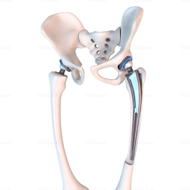 Hofteproteseimplantat installert i bekkenbenets 3D-modell