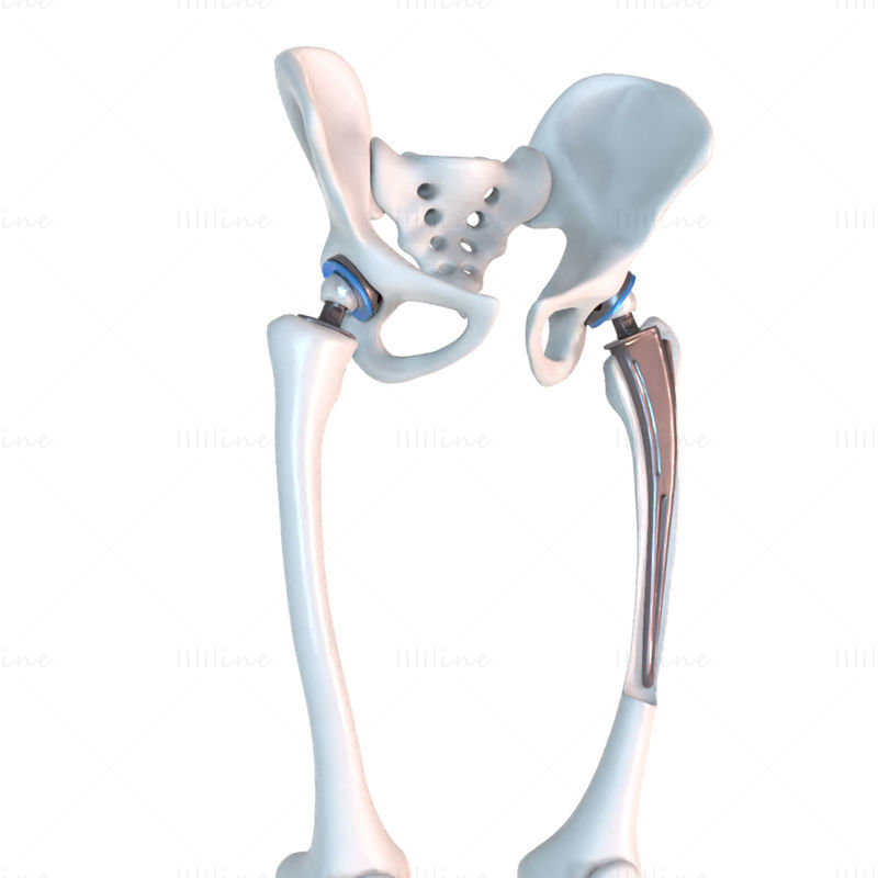 Имплантат для замены тазобедренного сустава, установленный в 3D-модель кости таза
