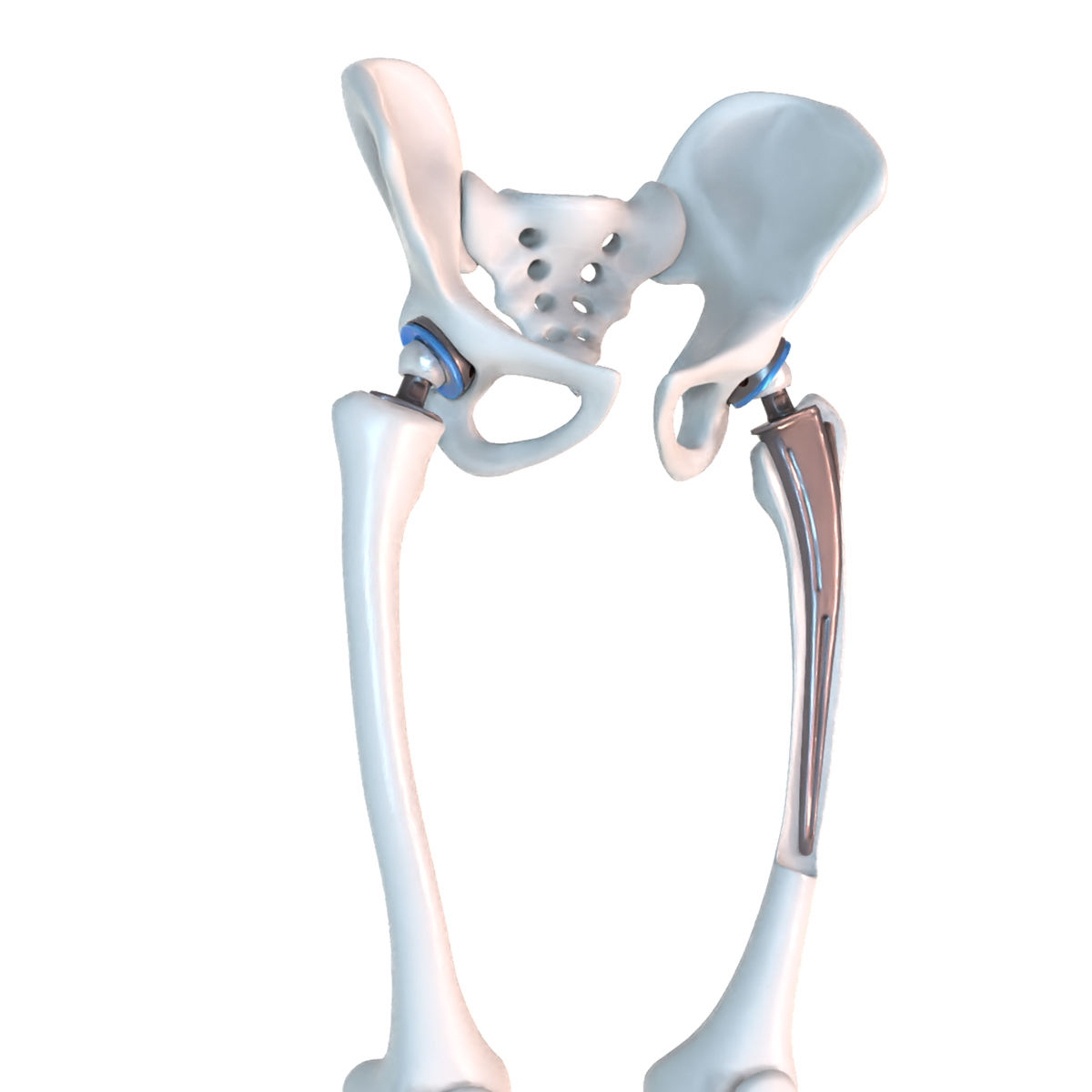 Hip replacement implant installed in the pelvis bone 3D model