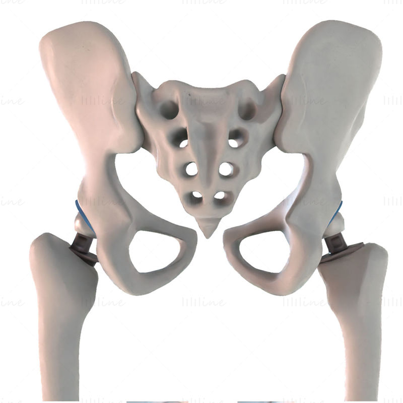 Implante de reemplazo de cadera instalado en el modelo 3D del hueso de la pelvis
