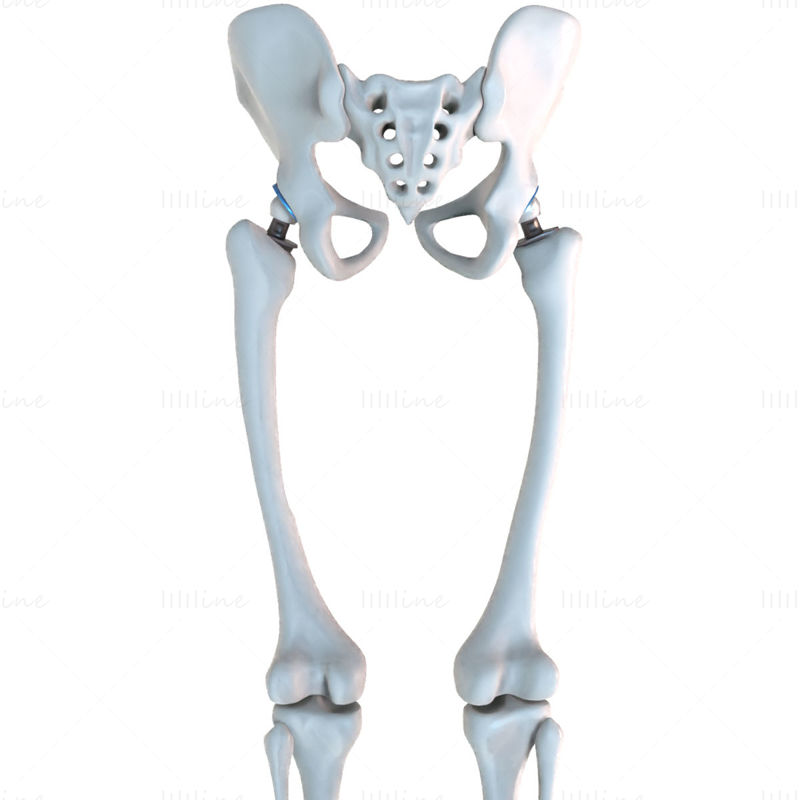 Impianto di sostituzione dell'anca installato nel modello 3D dell'osso pelvico
