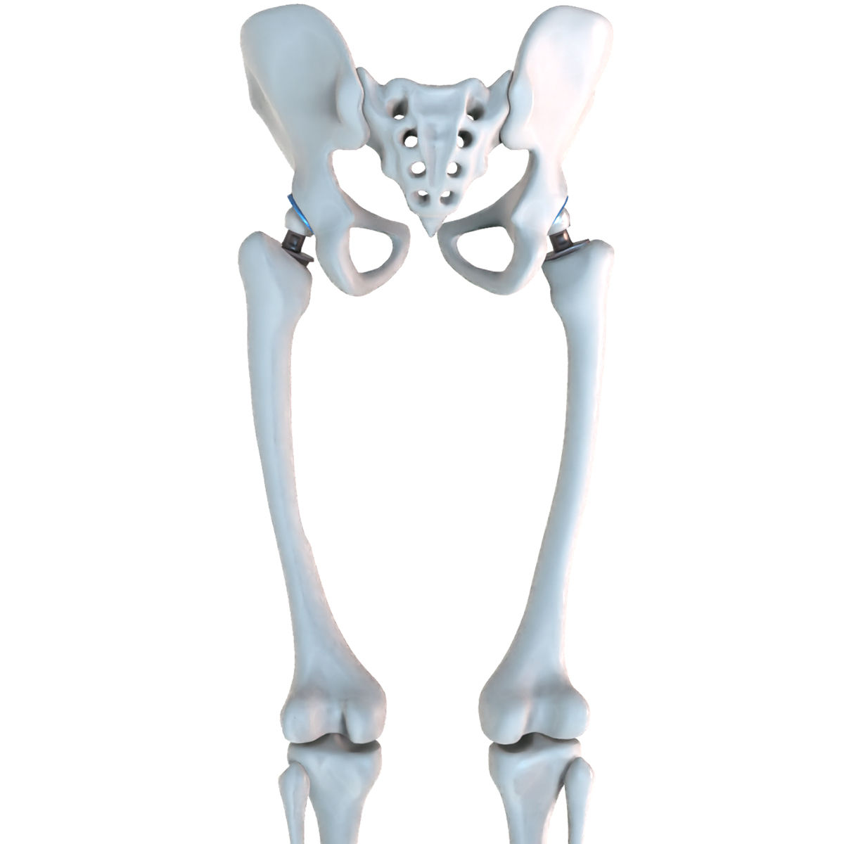 Hip replacement implant installed in the pelvis bone 3D model