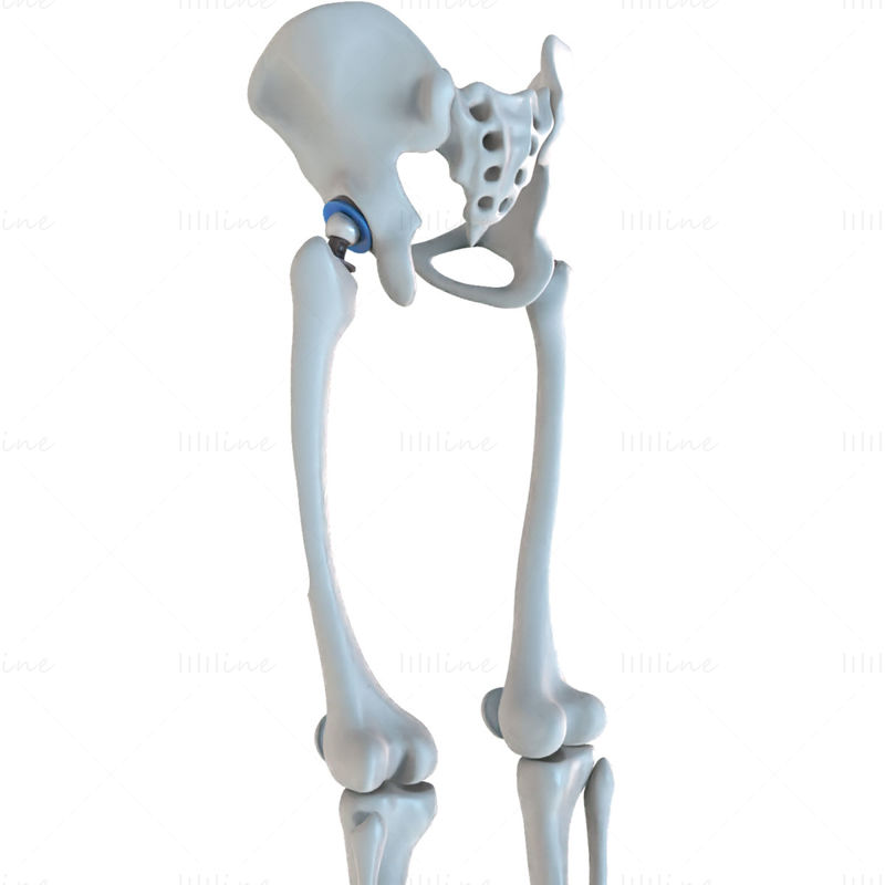 Implante de reemplazo de cadera instalado en el modelo 3D del hueso de la pelvis