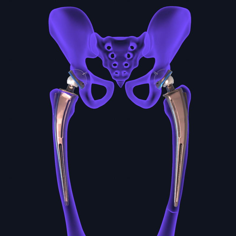 Impianto di sostituzione dell'anca installato nel modello 3D dell'osso pelvico