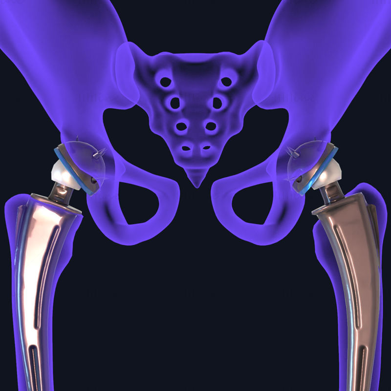 骨盤の骨に挿入された股関節置換インプラントの 3D モデル