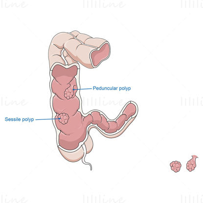 Vetor de pólipos do cólon intestinal