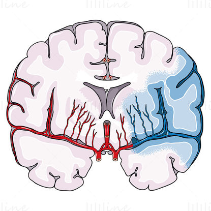 ilustração científica do vetor de acidente vascular cerebral isquêmico