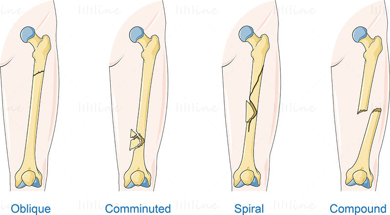 Kind of fractures vector scientific illustration