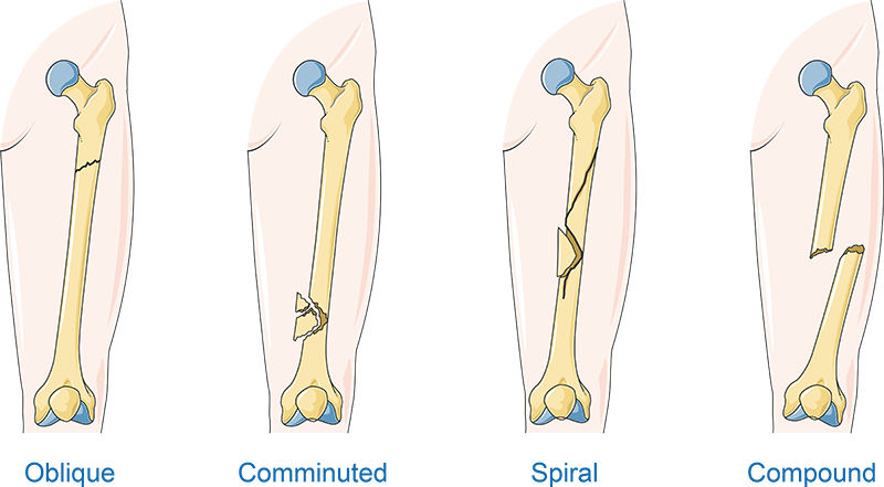 Kind of fractures vector scientific illustration