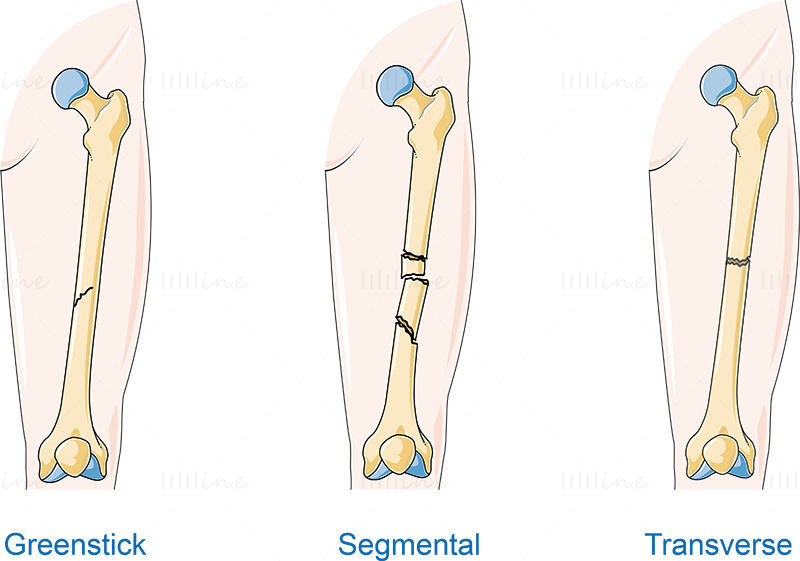 Kind of fractures vector scientific illustration