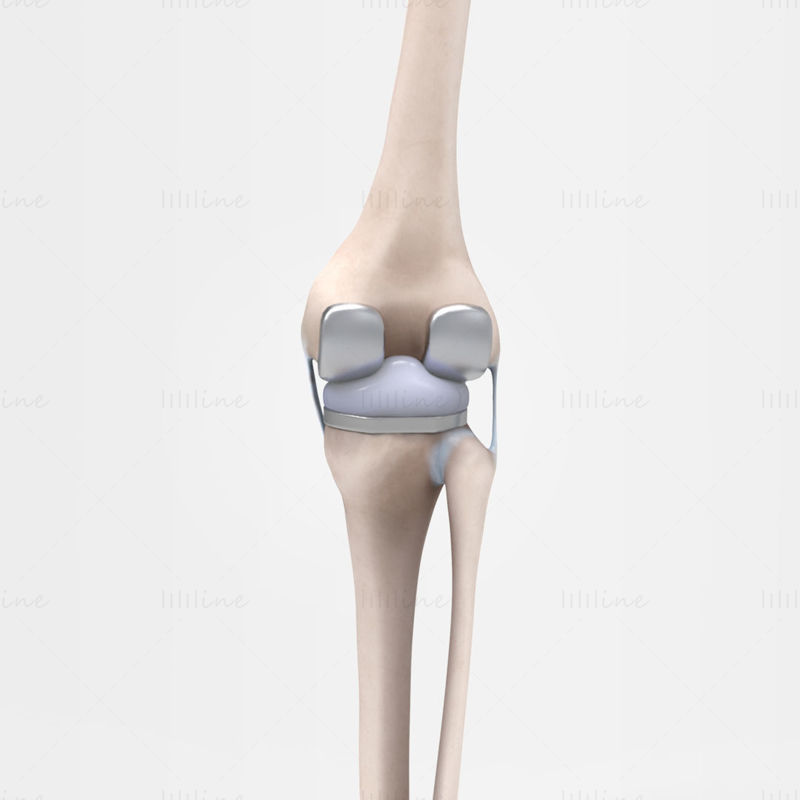 Knee Replacement 3D Scene