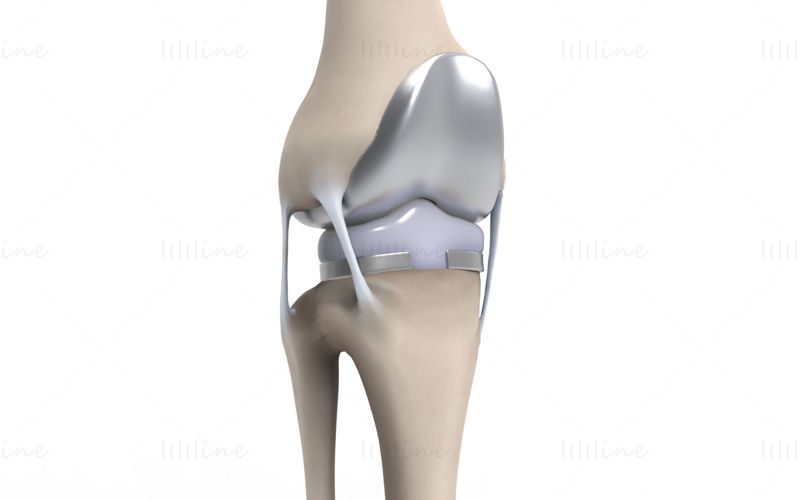 膝関節置換術の 3D シーン
