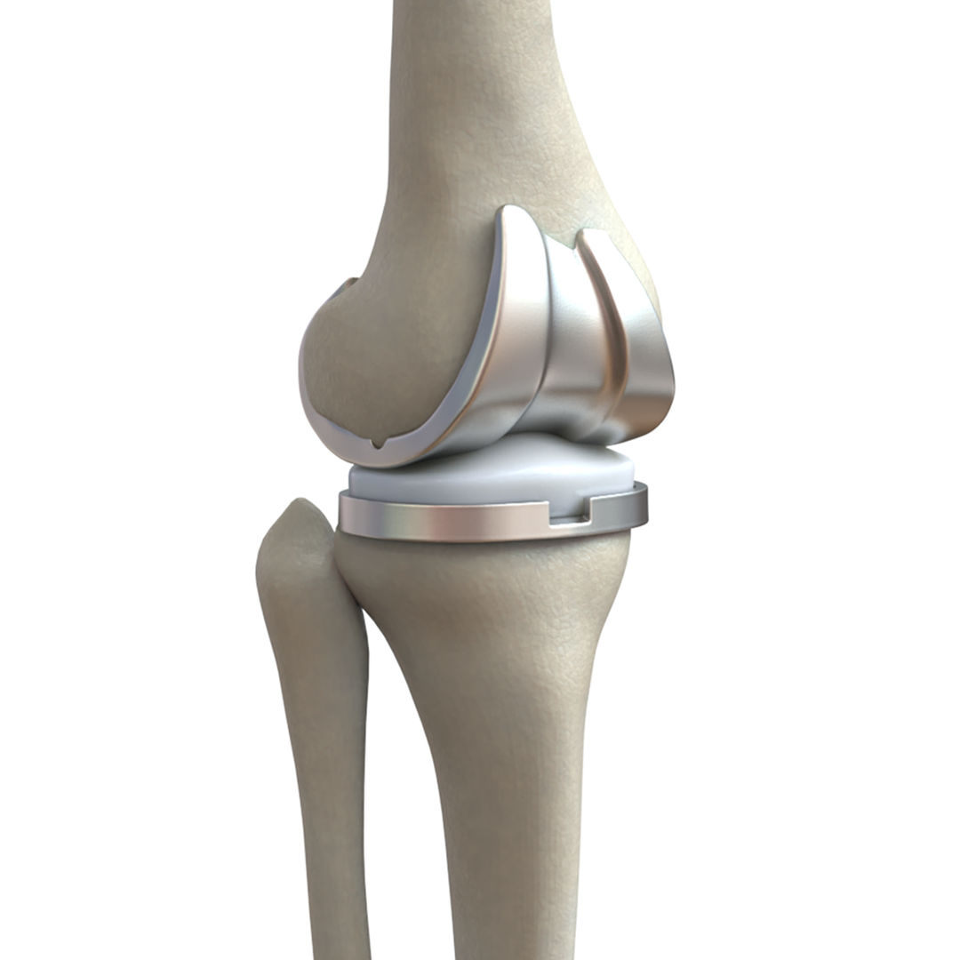 Knee Replacement Implant 3D Model