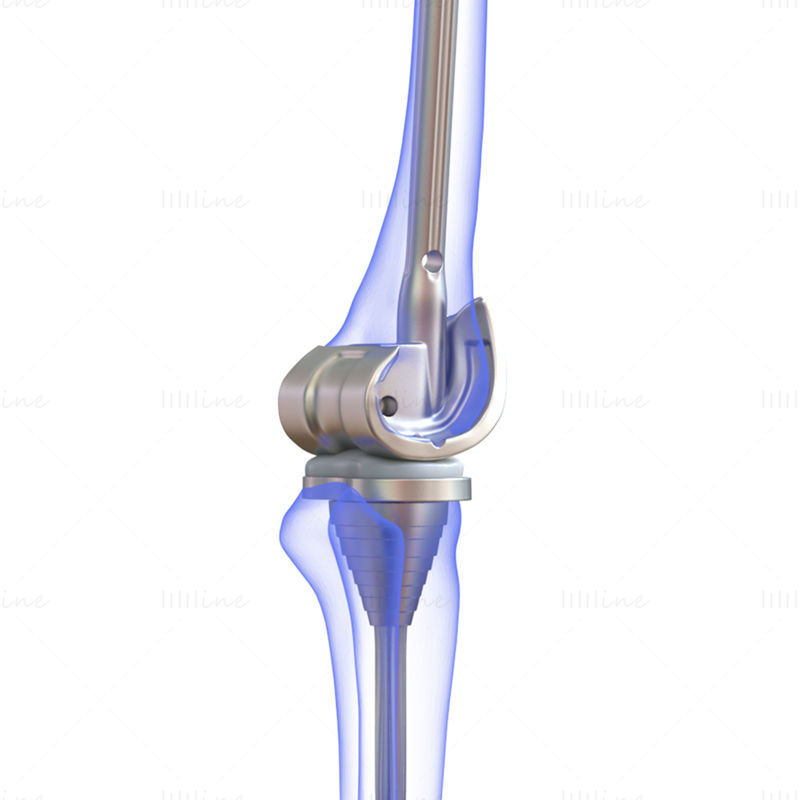 Knee Replacement Implant 3D Model