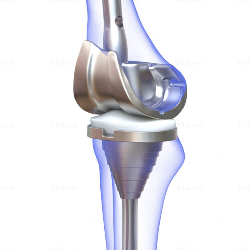 Modelo 3D de implante de reemplazo de rodilla