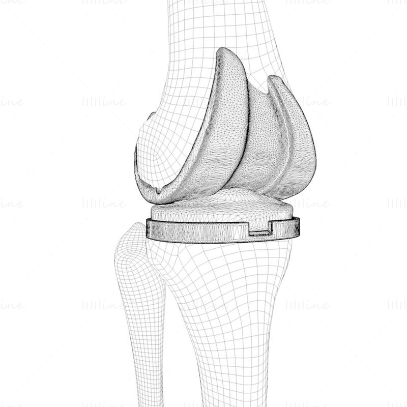Modelo 3D de implante de reemplazo de rodilla