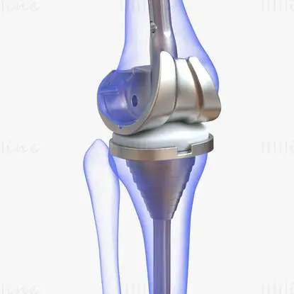 Ilustración médica de implante de reemplazo de rodilla