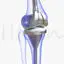 Knee Replacement Implant medical illustration