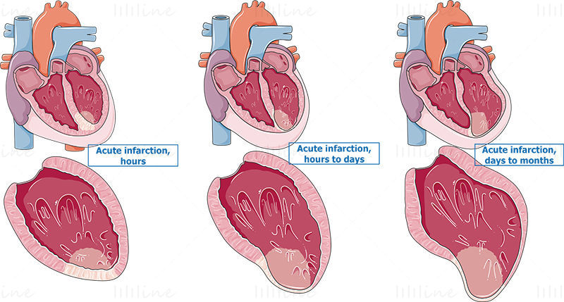 Left Ventricular Remodeling Following Myocardial Infarction vector