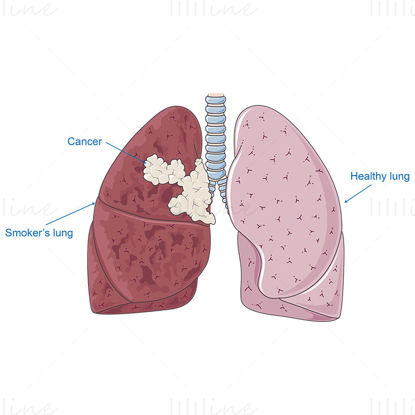 Lung cancer vector scientific illustration
