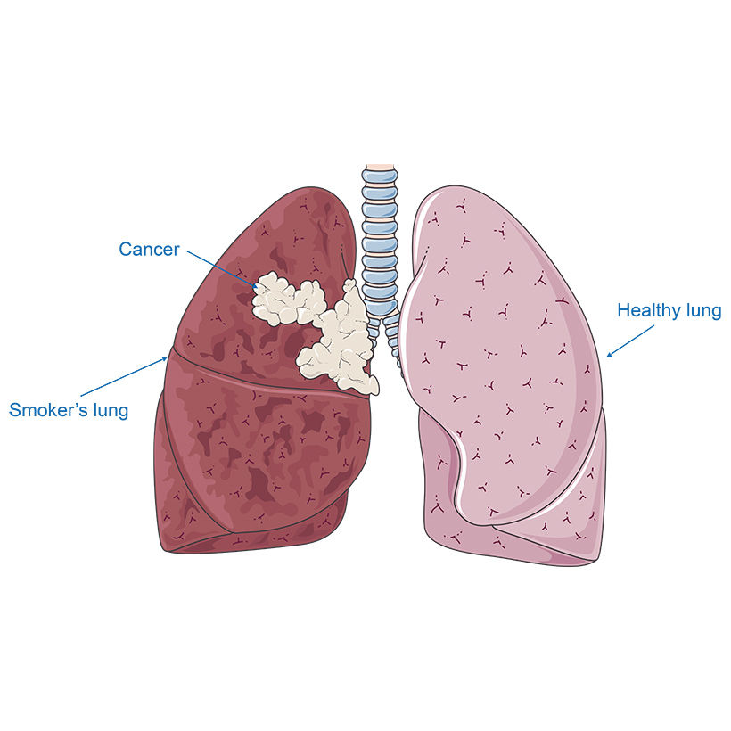 Lung cancer vector scientific illustration