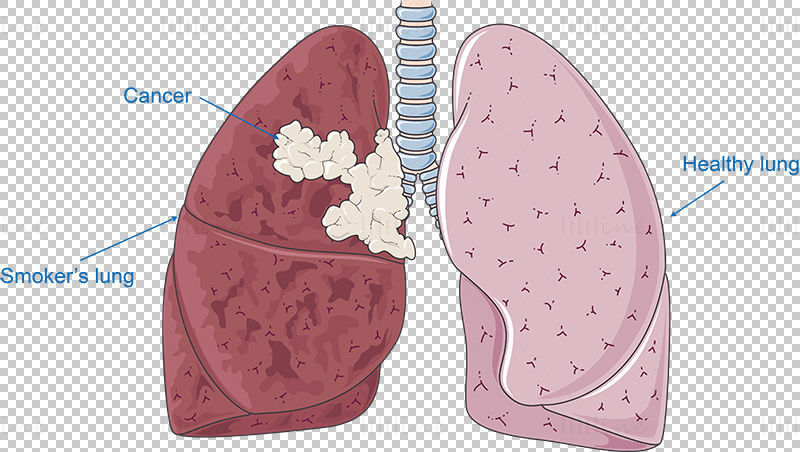 Lung cancer vector scientific illustration