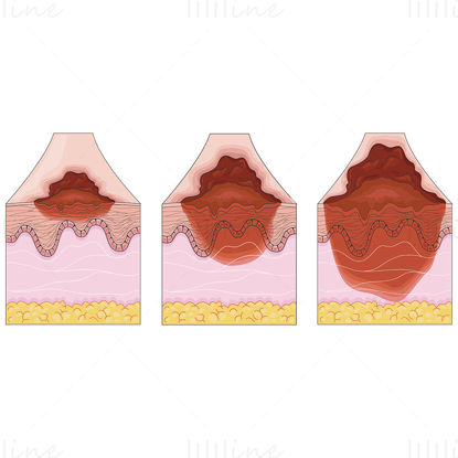 Melanoma sections vector