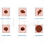Melanoma vector scientific illustration