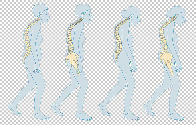 Menopause Osteoporosis vector scientific illustration
