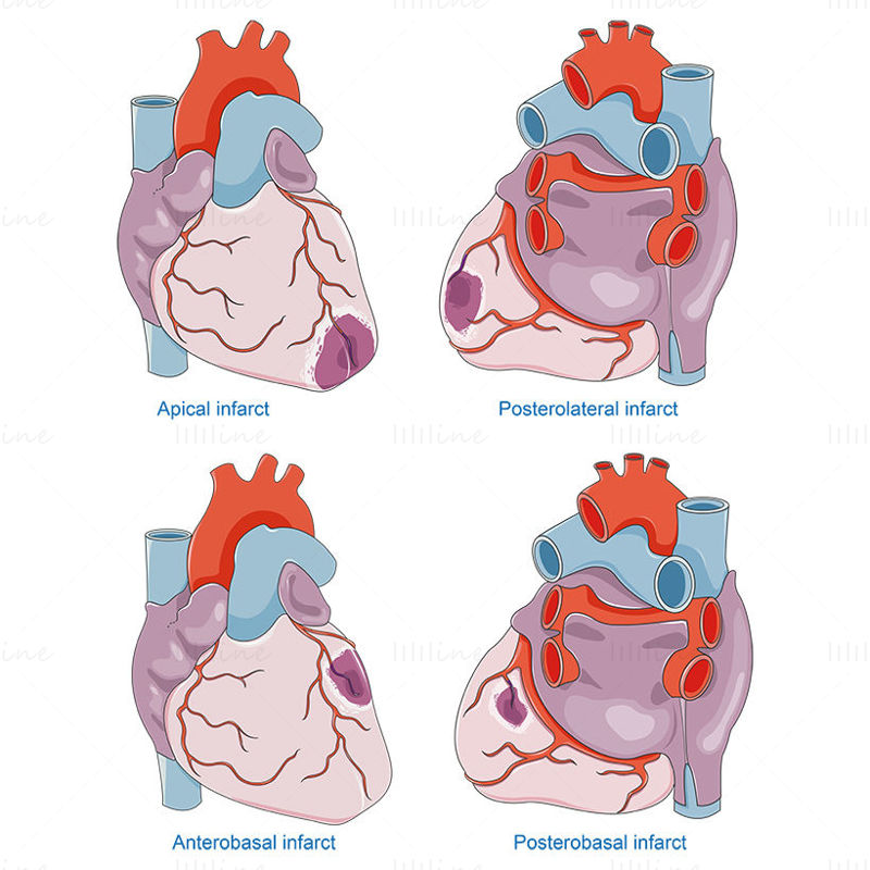 Myocardial infarctions vector