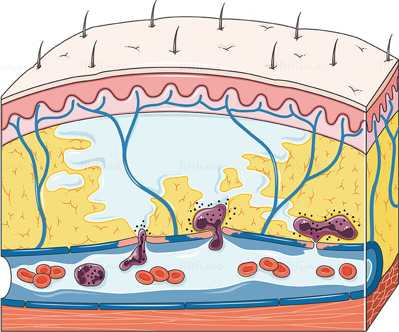 Vector de edema