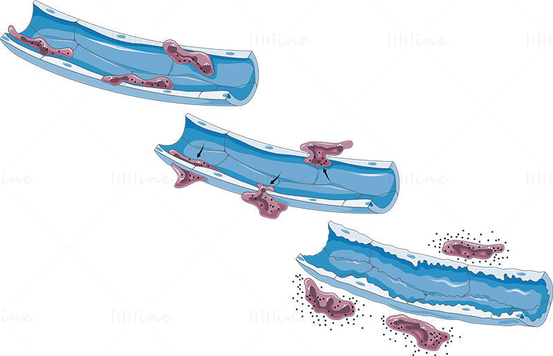 Vector de edema