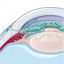 Open angle glaucoma vector illustration