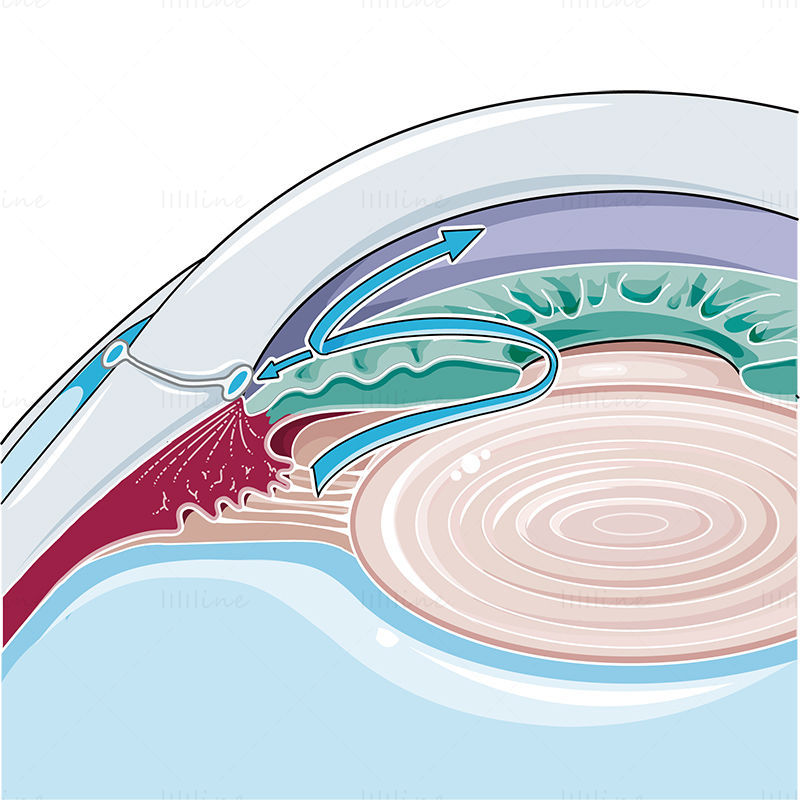 Ilustración de vector de glaucoma de ángulo abierto