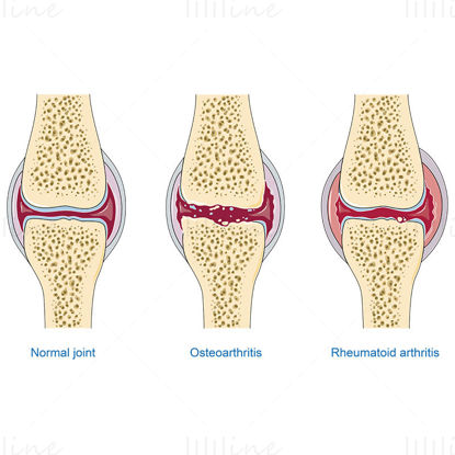 Osteoarthritis und rheumatoide Arthritis vektorwissenschaftliche Illustration