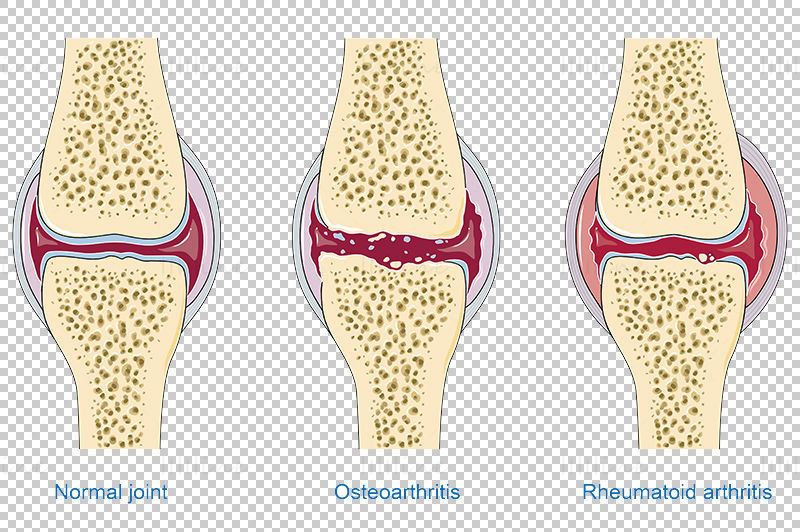 Osteoarthritis and rheumatoid arthritis vector scientific illustration