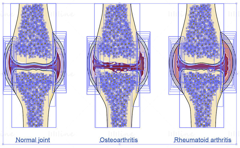 Artrose en reumatoïde artritis vector wetenschappelijke illustratie