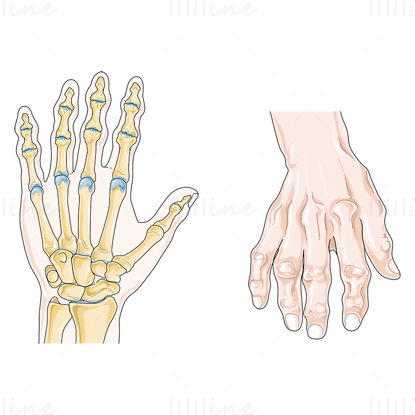 Wissenschaftliche Illustration des Osteoarthritis-Vektors
