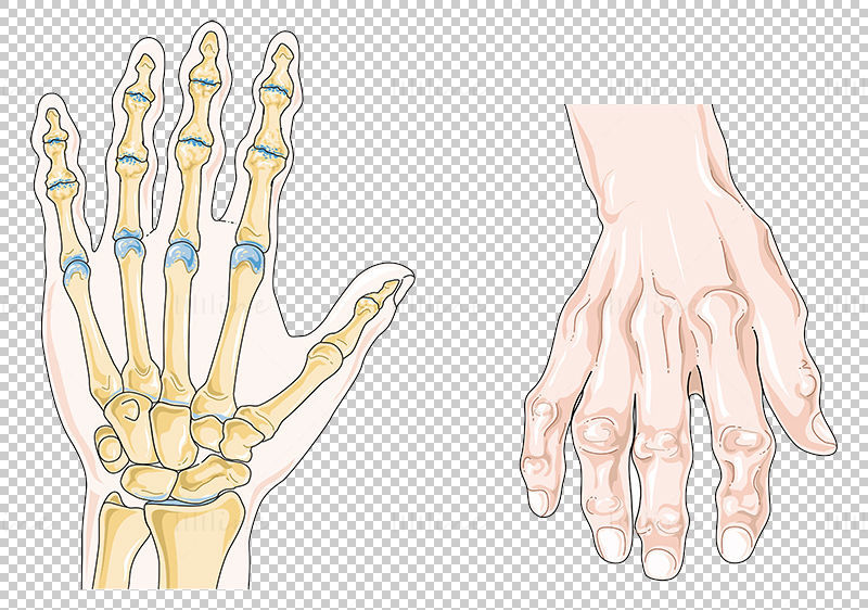 Artrose vector wetenschappelijke illustratie